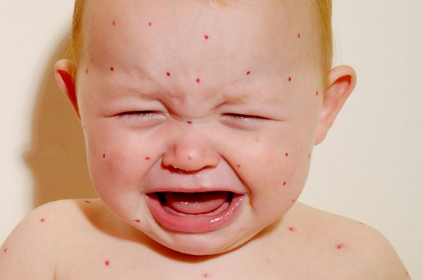 Nguyễn nhân khiến sốt phát ban gây ngứa và cách điều trị hiệu quả tại nhà